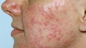 Rosacea Treatment
